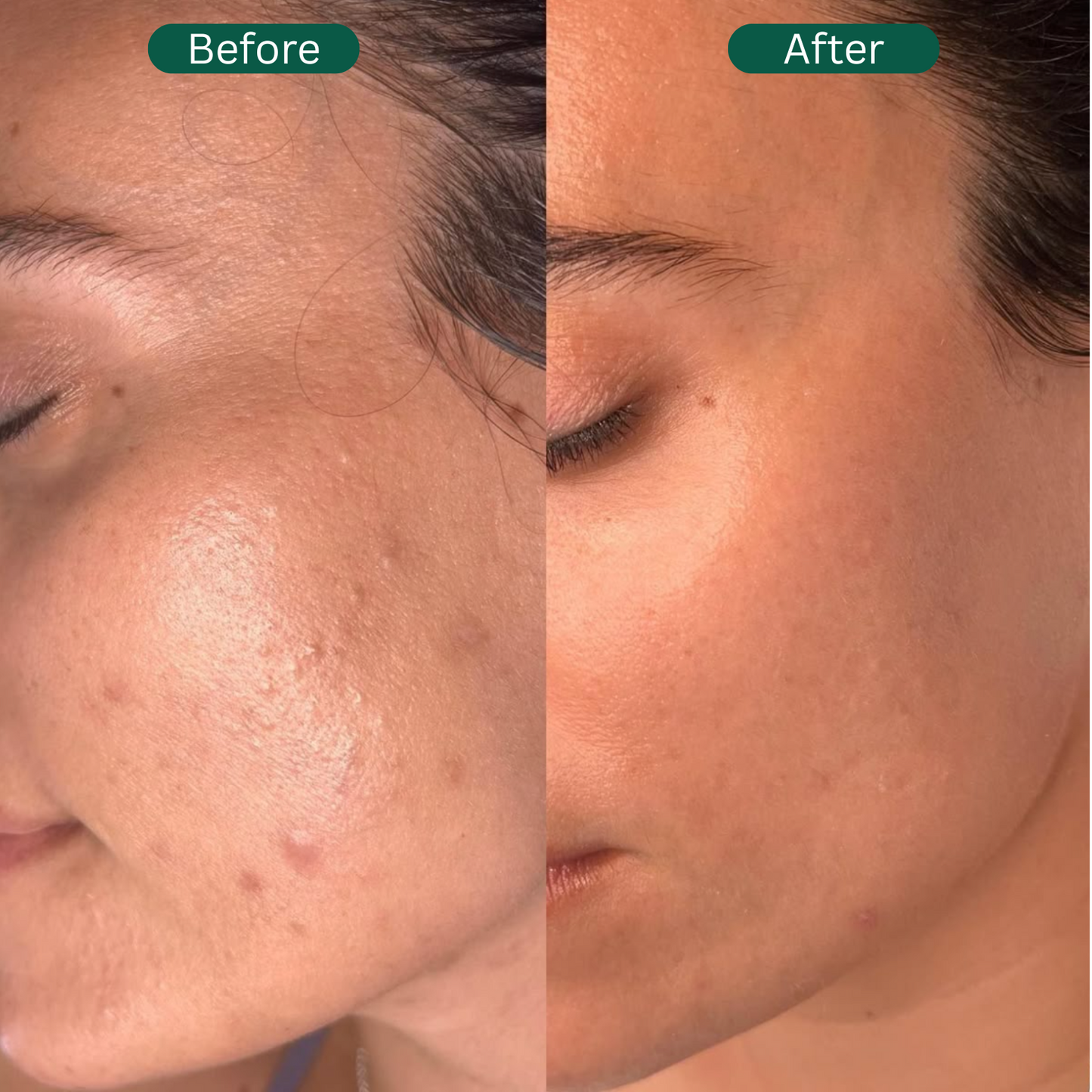 Lira I  Oxygen-Basil Fusion Mask